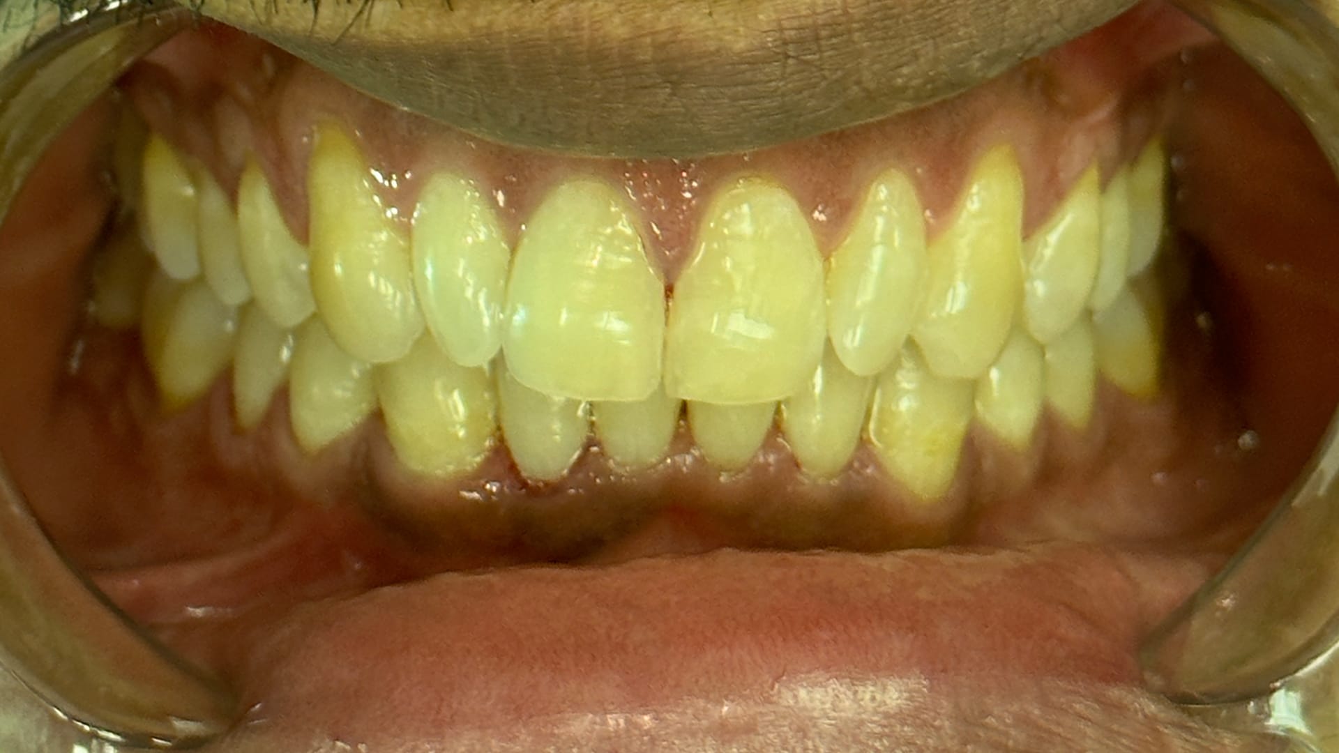 Dental Alignment