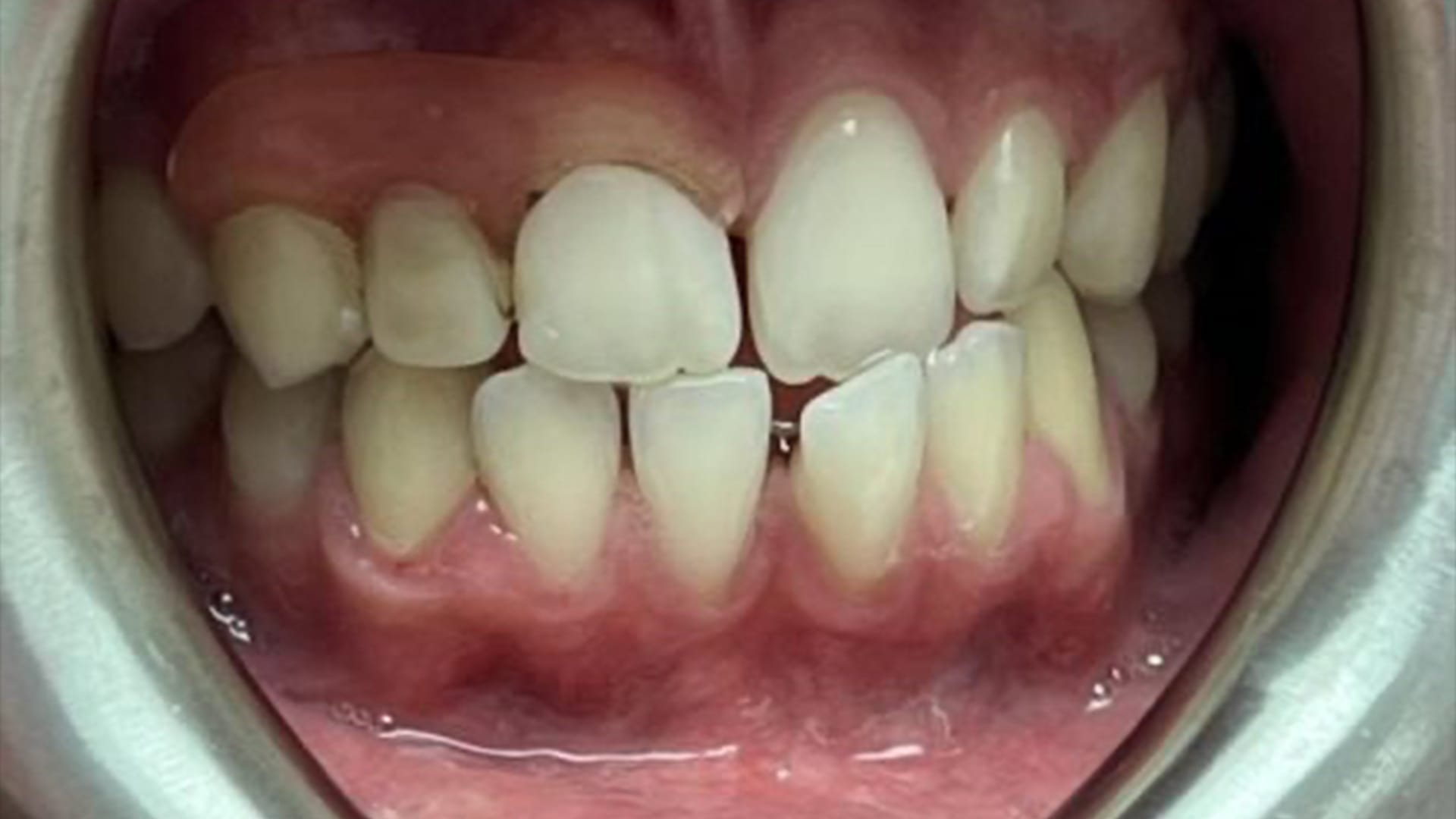 Crooked Teeth