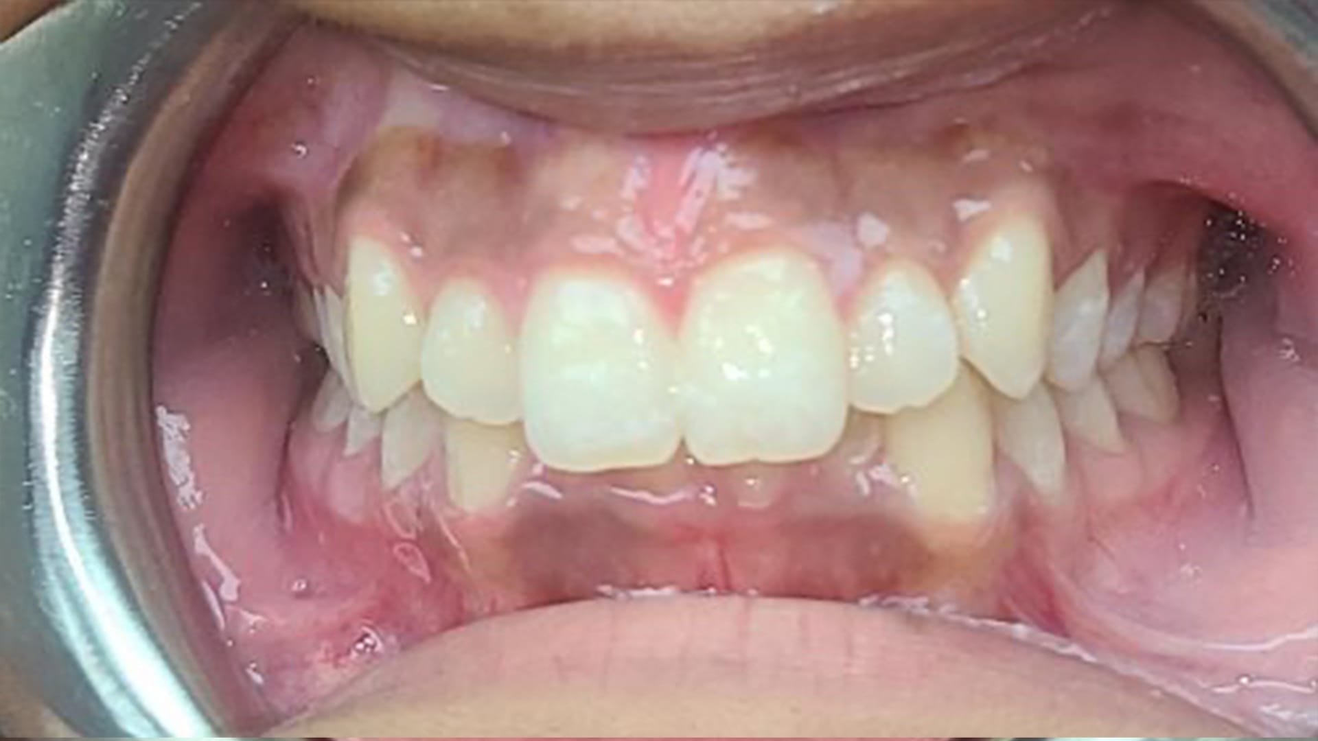 Teeth Alignment