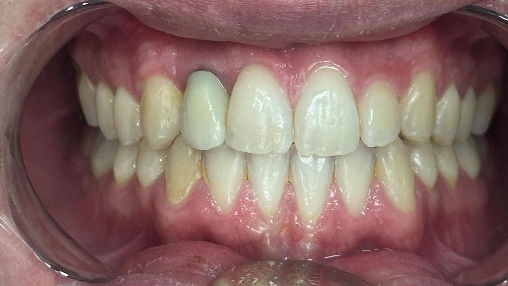 Dental Veneers