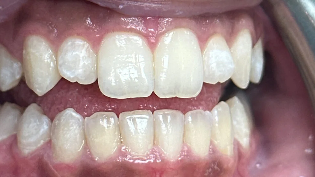 Composite Fillings