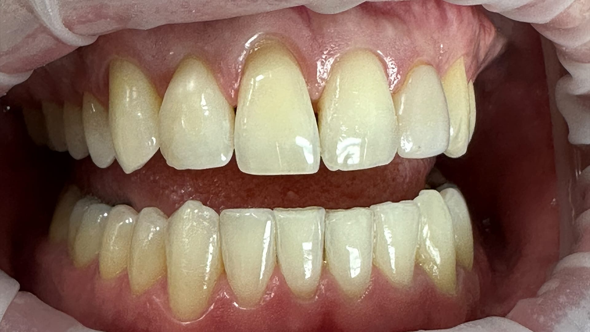 Dental Veneers